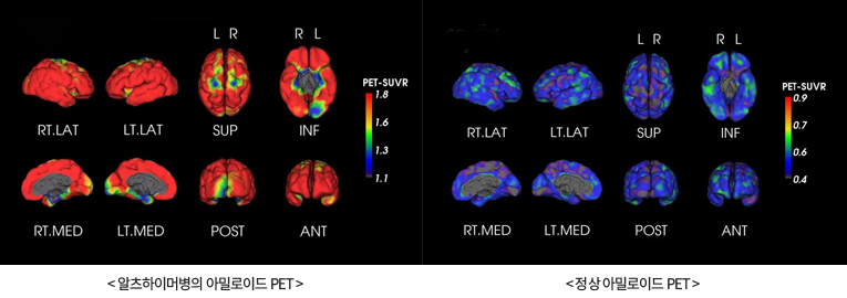 알츠하이머병 PET사진