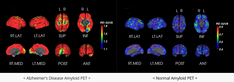 알츠하이머병 PET사진
