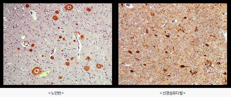 알츠하이머병 조직 소견