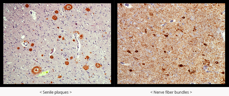 알츠하이머병 조직 소견
